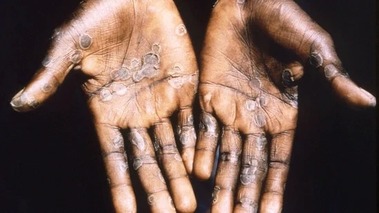 Ebnoyi records first case of monkeypox