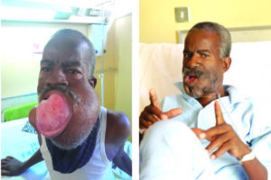 Laston Kwinika before and after the Mouth Tumor Surgery